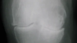 Radiografía de rodilla con signos de osteoartritis, la afección que trata la embolización de arteria genicular