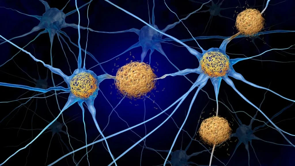 Neuronas cerebrales con placas de proteína amiloide analizadas bajo microscopio.